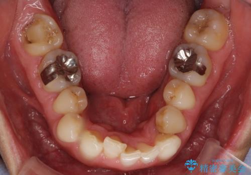 歯並びをきれいにしたい、歯を真っ白にしたい 40代男性の治療前