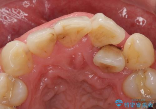 歯並びをきれいにしたい、歯を真っ白にしたい 40代男性の治療前