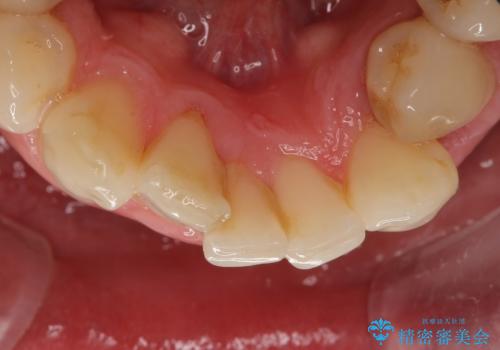 歯並びをきれいにしたい、歯を真っ白にしたい 40代男性の治療前
