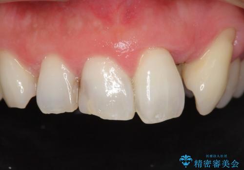 歯並びをきれいにしたい、歯を真っ白にしたい 40代男性の治療前