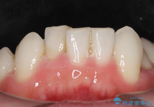 歯並びをきれいにしたい、歯を真っ白にしたい 40代男性の治療前