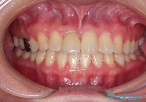 インビザラインにて矯正治療後の前歯のセラミッククラウン治療の症例 治療後