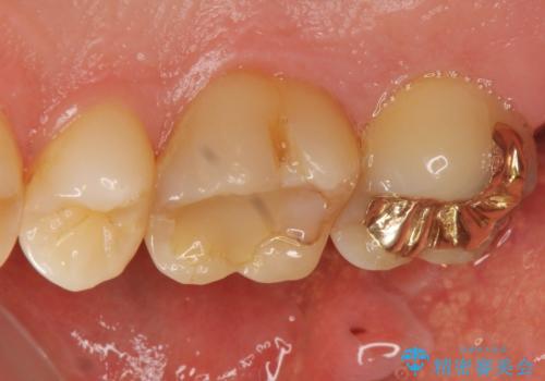 奥歯のゴールドインレーによる虫歯治療の症例 治療前