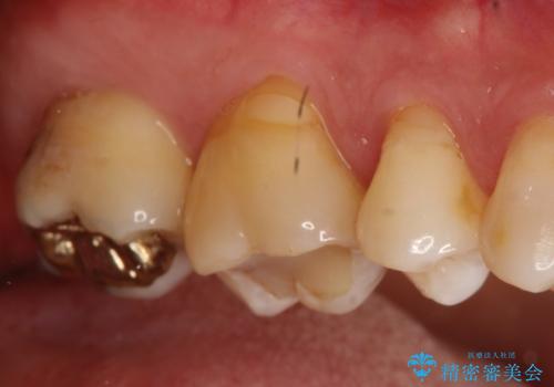 奥歯のゴールドインレーによる虫歯治療の治療前