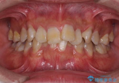 口元の突出感と叢生 ワイヤー装置による抜歯矯正の症例 治療前