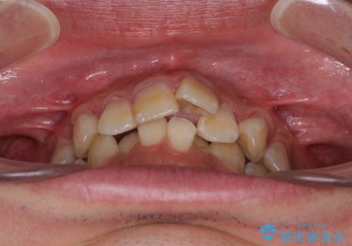 口元の突出感と叢生　ワイヤー装置による抜歯矯正の治療前