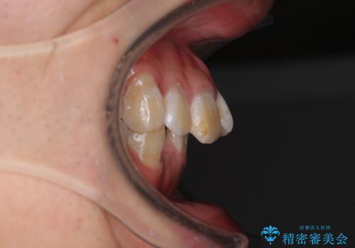 口元の突出感と叢生　ワイヤー装置による抜歯矯正の治療前