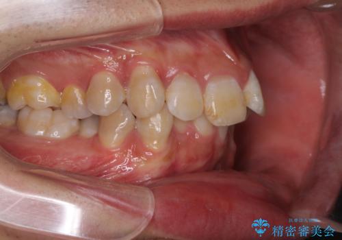 口元の突出感と叢生 ワイヤー装置による抜歯矯正の治療前