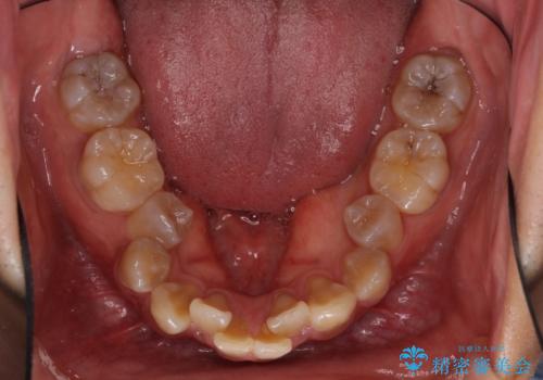 口元の突出感と叢生 ワイヤー装置による抜歯矯正の治療前