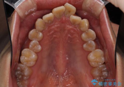 口元の突出感と叢生 ワイヤー装置による抜歯矯正の治療前