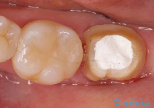 オールセラミッククラウン 痛みが引かない歯の治療の治療前