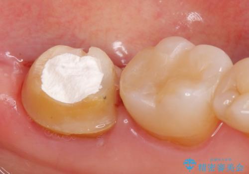 オールセラミッククラウン 痛みが引かない歯の治療の治療前