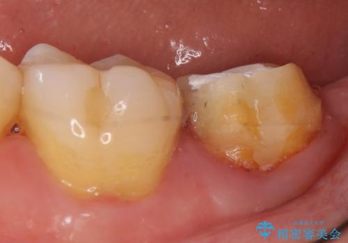 オールセラミッククラウン 痛みが引かない歯の治療の治療前