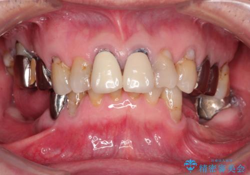 奥歯がなくてかめない　入れ歯とクラウンでの全顎治療の症例 治療前