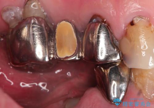 奥歯がなくてかめない 入れ歯とクラウンでの全顎治療の治療前