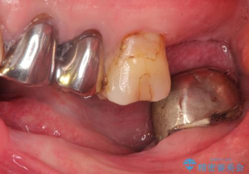 奥歯がなくてかめない 入れ歯とクラウンでの全顎治療の治療前