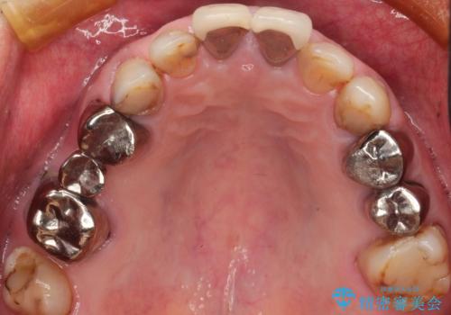 奥歯がなくてかめない 入れ歯とクラウンでの全顎治療の治療前