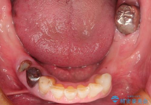 奥歯がなくてかめない 入れ歯とクラウンでの全顎治療の治療前