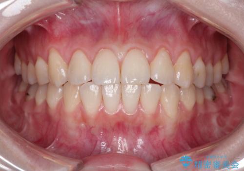 前歯の歯肉退縮 歯周形成外科(歯冠側移動術)の治療前