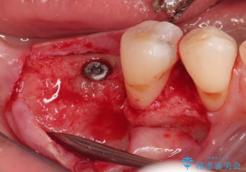 奥歯が痛い。抜歯～奥歯のインプラント　の治療中