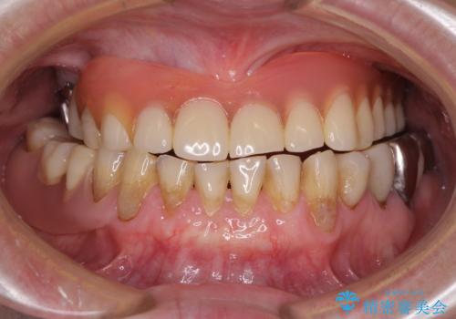 前歯の歯肉退縮 歯肉移植による根面被覆の治療後