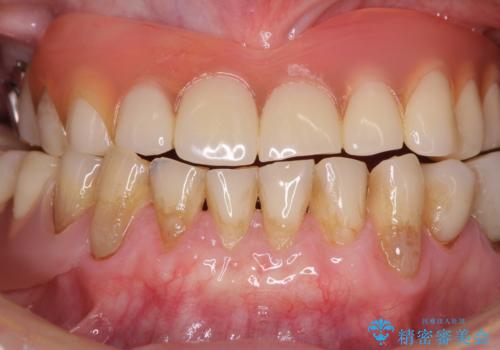 前歯の歯肉退縮 歯肉移植による根面被覆の治療後