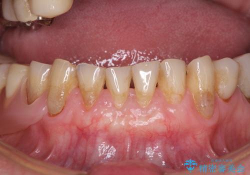 前歯の歯肉退縮 歯肉移植による根面被覆の症例 治療後