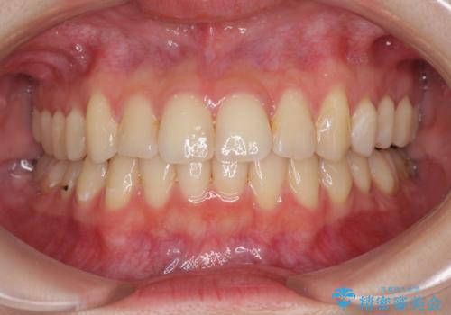 軽度な後戻りをインビザライン・ライトで改善の治療中