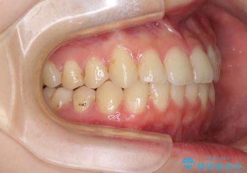 軽度な後戻りをインビザライン・ライトで改善の治療中