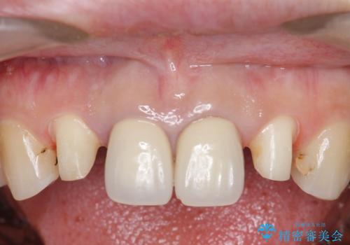 オールセラミッククラウン　前歯の劣化した古い樹脂をセラミックにの治療中