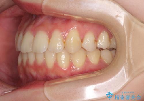 軽度な後戻りをインビザライン・ライトで改善の治療中