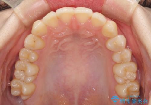 軽度な後戻りをインビザライン・ライトで改善の治療中