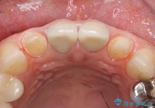 オールセラミッククラウン　前歯の劣化した古い樹脂をセラミックにの治療中