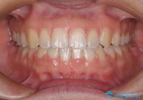 前歯の隙間を閉じたい　短期間でのワイヤー矯正の症例 治療後