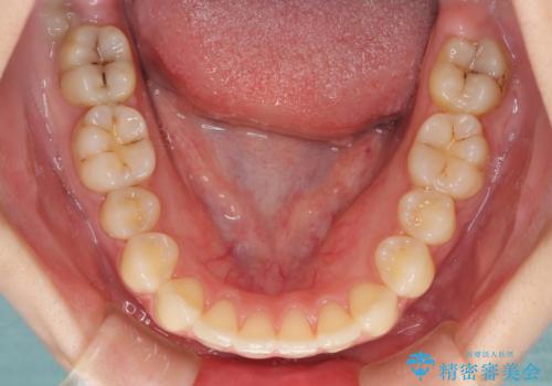 軽度な後戻りをインビザライン・ライトで改善の治療中