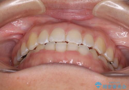 前歯の隙間を閉じたい　短期間でのワイヤー矯正の治療後