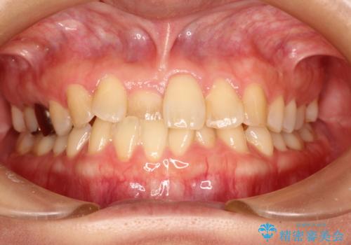 インビザラインにて矯正治療後の前歯のセラミッククラウン治療の症例 治療前