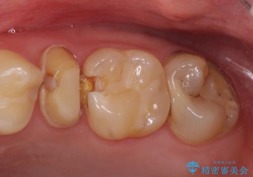 オールセラミッククラウン 痛みでものが咬めない歯の治療の治療前