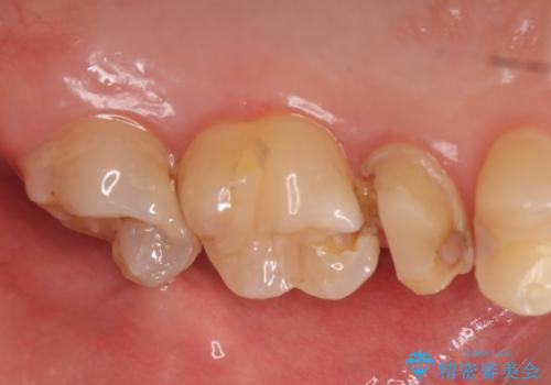 オールセラミッククラウン 痛みでものが咬めない歯の治療の治療前