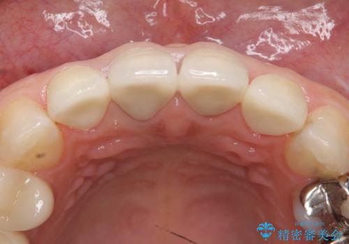 オールセラミッククラウン　前歯の劣化した古い樹脂をセラミックにの治療後