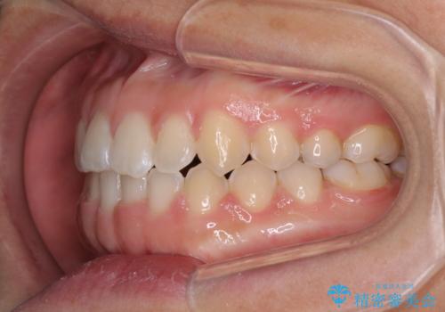 前歯の隙間を閉じたい　短期間でのワイヤー矯正の治療後