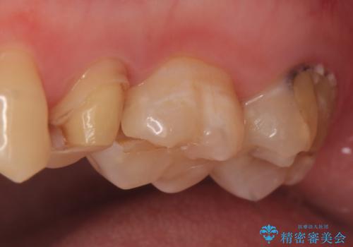 オールセラミッククラウン 痛みでものが咬めない歯の治療の治療前