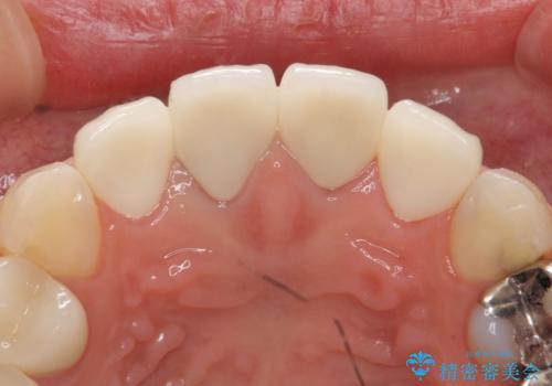 オールセラミッククラウン　前歯の劣化した古い樹脂をセラミックにの治療後