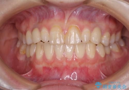 欠損と残存乳歯　矯正治療とインプラント治療