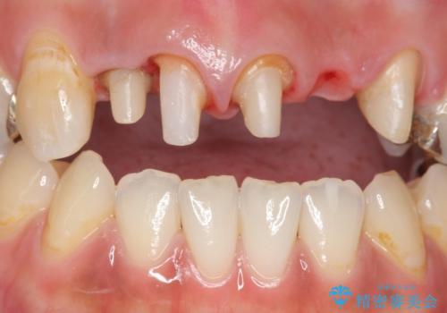 オールセラミッククラウン　気になる歯茎と被せ物の隙間の改善の治療中