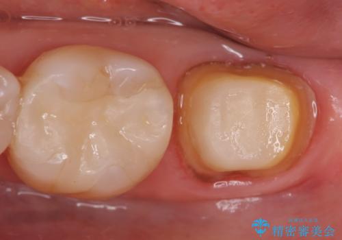 オールセラミッククラウン 痛みが引かない歯の治療の治療中