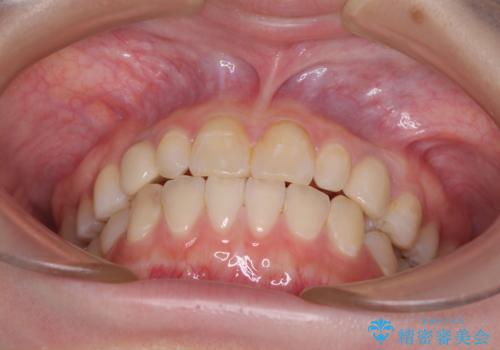 欠損と残存乳歯 矯正治療とインプラント治療の治療後