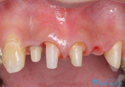 オールセラミッククラウン 気になる歯茎と被せ物の隙間の改善の治療中