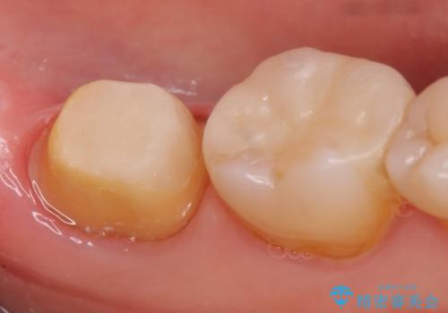 オールセラミッククラウン 痛みが引かない歯の治療の治療中