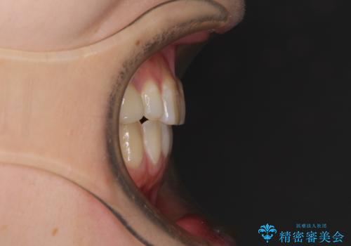 欠損と残存乳歯 矯正治療とインプラント治療の治療後